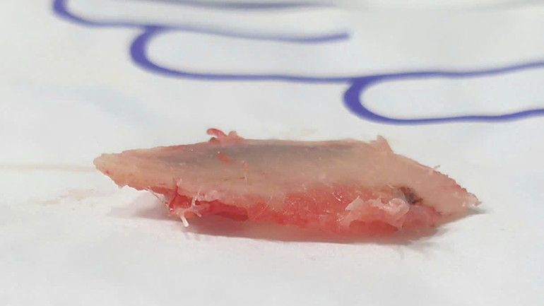 Bệnh nhân được phẫu thuật nội soi khoang màng phổi hoàn toàn, mảnh xương sườn gãy vụn được lấy ra.