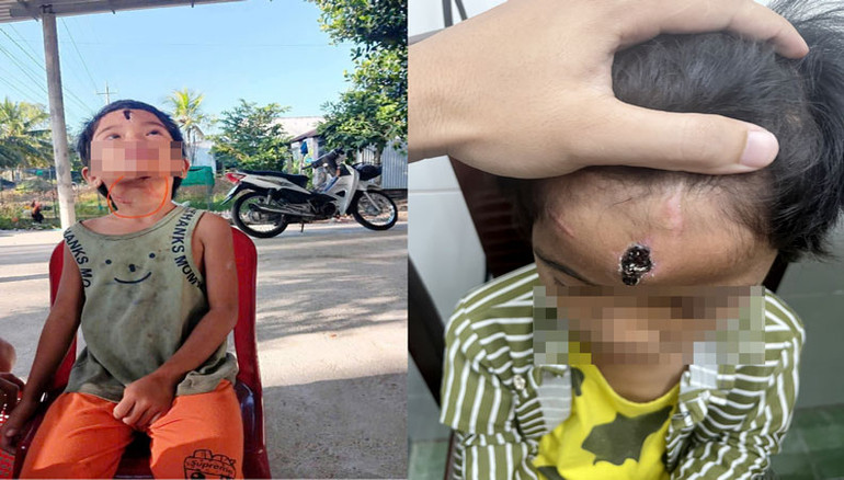 Vết thương cháu N.T.N. bị cha dượng đánh đập.