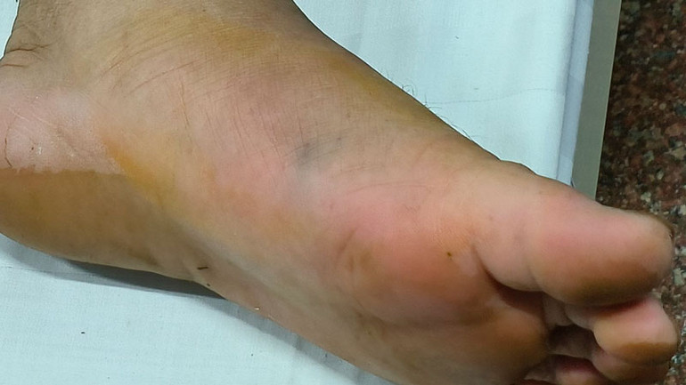 Vết thương của ông N. do rắn đuôi đỏ cắn.