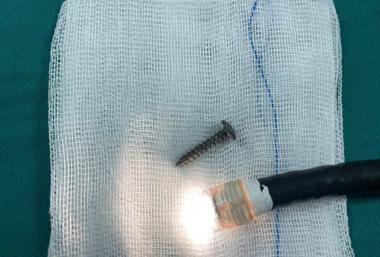 Cây đinh vít dài 24,5mm được các bác sĩ lấy ra từ bụng cháu bé.