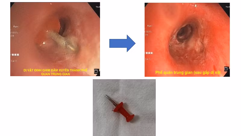 Hình ảnh nội soi ống mềm gắp dị vật đinh ghim xuyên thành phế quản trung gian.