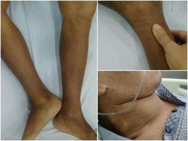 Phù niêm là biểu hiện ít gặp nhất của bệnh Basedow. Phù niêm là biểu hiện ít gặp nhất của bệnh Basedow.