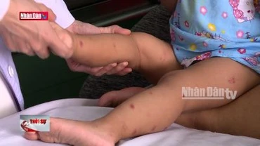 Đề xuất tiêm miễn phí vắcxin sốt xuất huyết