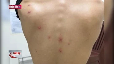 Việt Nam có ca tử vong đầu tiên liên quan bệnh đậu mùa khỉ