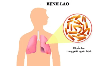 Thủ tướng Chính phủ chỉ đạo tăng cường công tác phòng, chống bệnh Lao