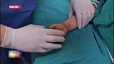 Xuyên đêm nối bàn tay đứt lìa cho cháu bé 21 tháng tuổi