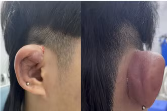 Bệnh nhân sưng nóng đỏ ở vành tai phải, có lỗ rò mủ.