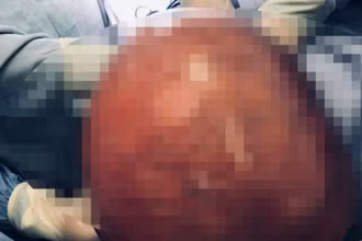 Khối u xơ tử cung nặng tới 10kg.