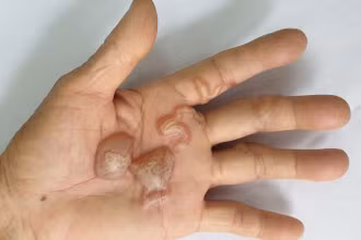 Ấu trùng giun móc chó, mèo tạo đường hầm và gây tổn thương trên da người.
