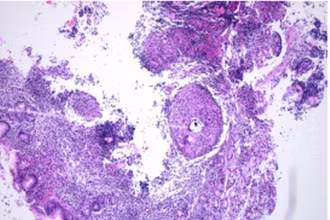 Hình ảnh xét nghiệm mô bệnh học cho kết quả tổn thương viêm hạt hướng đến do Mycobacterium.