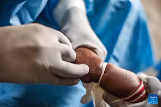 Một đứa trẻ bị mắc bệnh đậu mùa khỉ đang được điều trị tại bệnh viện ở vùng Nyiragongo gần Goma, tỉnh Bắc Kivu, miền đông Cộng hòa Dân chủ Congo. Ảnh minh hoạ: Tân Hoa xã