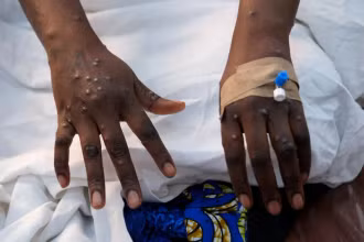 Một bệnh nhân bị phát ban trên da do vi rút đậu mùa khỉ. Ảnh: Reuters