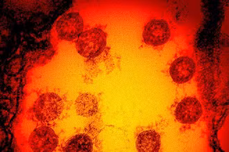 Ảnh vi điện tử được tăng cường màu chụp lại các hạt virus SARS-CoV-2 được phân lập từ mẫu bệnh phẩm của 1 bệnh nhân. (Ảnh: Viện Dị ứng và bệnh truyền nhiễm quốc gia Mỹ)