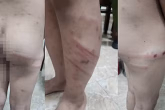 Hình ảnh cháu M. bị mẹ ruột và người tình của mẹ đánh đập gây thương tích nghiêm trọng.