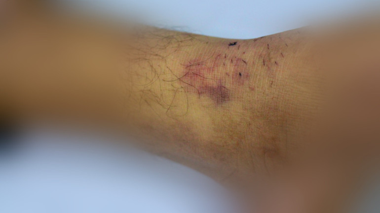 Sốc phản vệ do tự đắp thuốc điều trị khi bị rắn cắn 5c4d581e-aff2-47ce-9361-9925c3a7564e.jpg