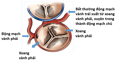 Hình ảnh bất thường động mạch vành trái của bệnh nhi 11 tuổi. hinh2.png