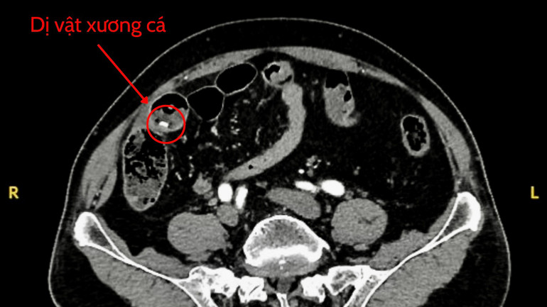 Hình chụp CT bụng bệnh nhân bị hóc dị vật. hinh-ct-bung1.jpg
