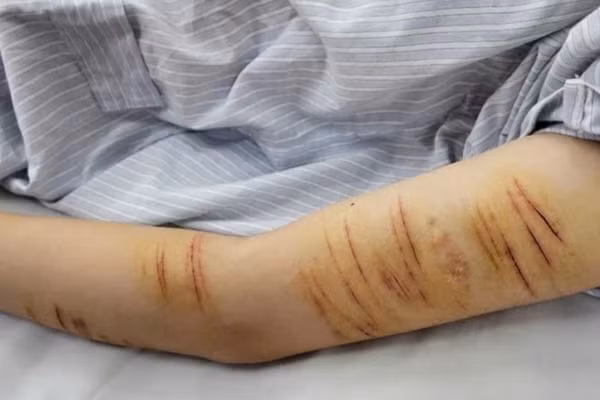 Vết rạch trên cánh tay nữ sinh N.M.A. (Ảnh: Bệnh viện cung cấp)