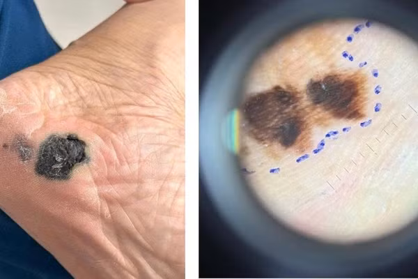 Hình ảnh ung thư tế bào hắc tố trên Dermoscope: màu sắc không đều, bất đối xứng. (Ảnh: Bác sĩ cung cấp)