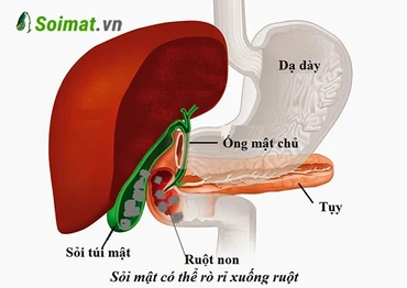 Chủ quan với sỏi túi mật, người phụ nữ bị tắc ruột