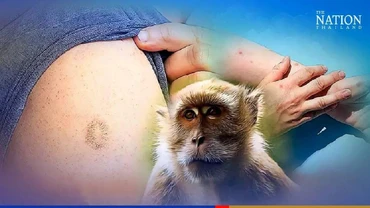 Nhiều nghiên cứu quốc tế gần đây chỉ ra rằng, việc tiêm phòng đậu mùa trước đây có thể bảo vệ tới 85% những người được tiêm vaccine. (Ảnh: The Nation)