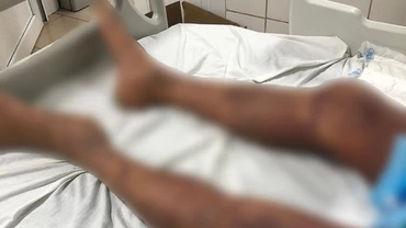 Một trường hợp toàn thân tím đen vì mắc liên cầu lợn. (Ảnh: Vietnam+)