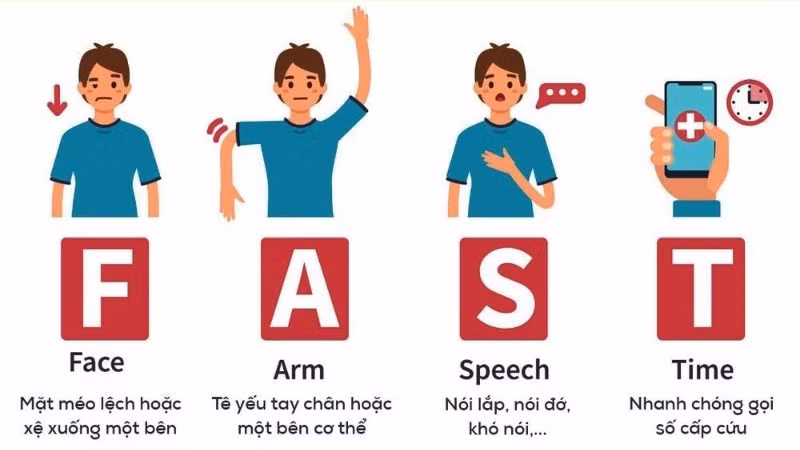 Nguyên tắc FAST của ngành y trong ứng cứu đột quỵ. 