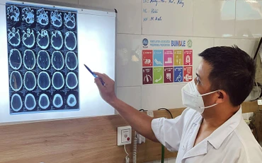 TS,BS Nguyễn Trung Nguyên chỉ ra các dấu hiệu tổn thương não của bệnh nhân sau khi uống rượu chứa cồn công nghiệp methanol.
