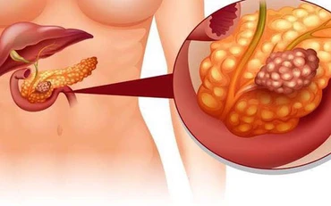 Rượu bia liên miên ba ngày Tết, coi chừng viêm tụy cấp