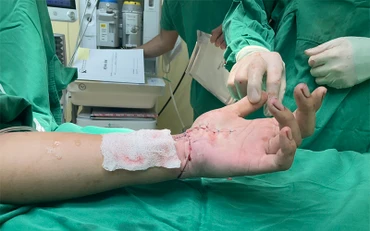Ca bệnh có bàn tay đứt lìa được nối ghép thành công.