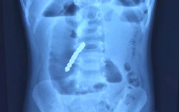 Hình ảnh chụp X-quang phát hiện bảy viên bi nam châm gây thủng ruột bệnh nhi.