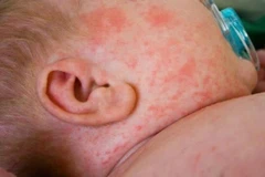 Triệu chứng dễ nhận biết của bệnh nhi mắc sởi là mẩn đỏ nổi khắp người