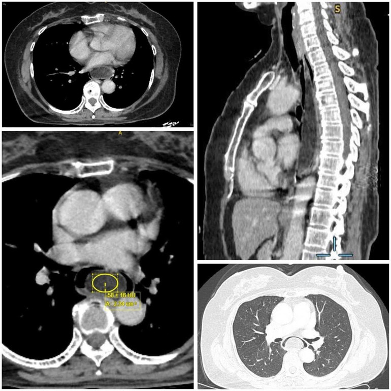 U mỡ thực quản “kích thước khủng” dưới niêm mạc khiến người bệnh nuốt nghẹn kéo dài k2.jpg