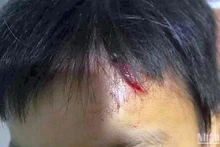 Vùng trán cháu L.M.T. bị rách da vào hôm người anh ruột phát hiện vụ việc. 