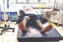 Cháu Y.N.N bị bỏng 2 chân khi được đưa vào Trung tâm Y tế huyện Ea H’leo khám, điều trị.