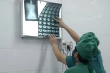 Các bác sĩ theo dõi viên đạn trong người anh Giáp qua phim chụp X-quang.