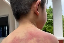 Cháu Đ bị nhiều vết bầm tím trên cơ thể do cha đánh.