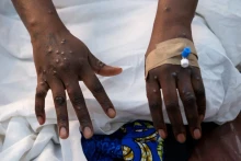 Một bệnh nhân bị phát ban trên da do vi rút đậu mùa khỉ. Ảnh: Reuters