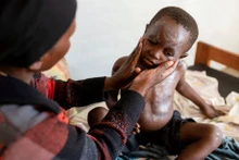 Một bệnh nhân đậu mùa khỉ đang được bôi thuốc lên da. Ảnh Reuters.