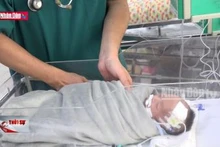 Cứu sống bé sơ sinh bị hoại tử ruột từ trong bụng mẹ