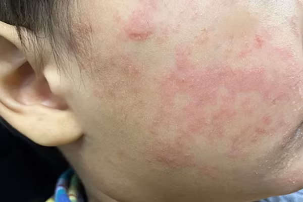 Má của một thiếu niên xuất hiện vết phát ban đặc trưng của bệnh sởi. (Ảnh: CDC Hoa Kỳ).