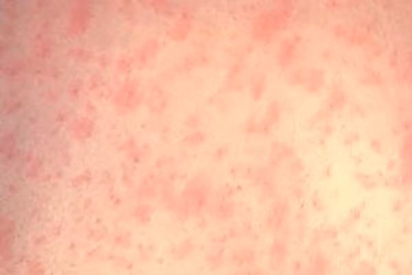 Da của bệnh nhân sau 3 ngày bị phát ban sởi. (Ảnh: CDC)
