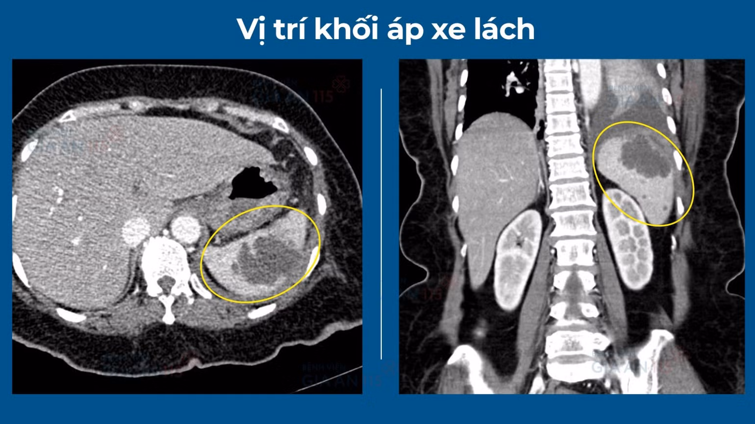 vi-tri-khoi-ap-xe-lach-4424.jpg
