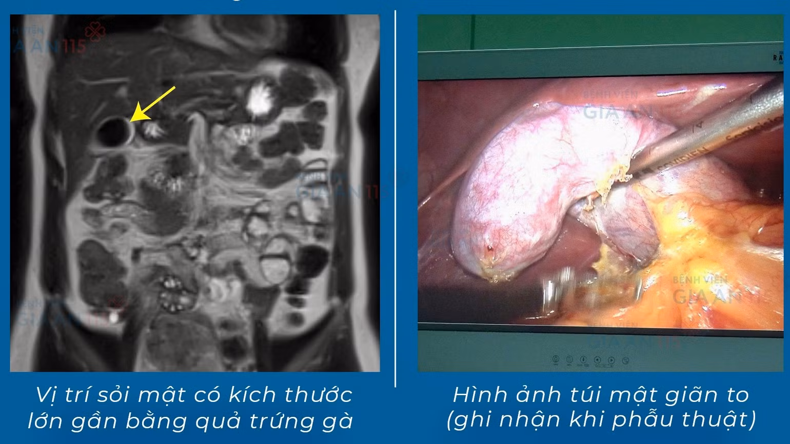 vi-tri-soi-mat-co-kich-thuoc-lon-gan-bang-qua-trung-ga-2.jpg