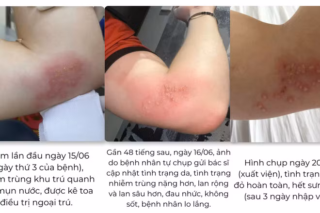 Diễn tiến điều trị ca zona tại Bệnh viện quốc tế City.