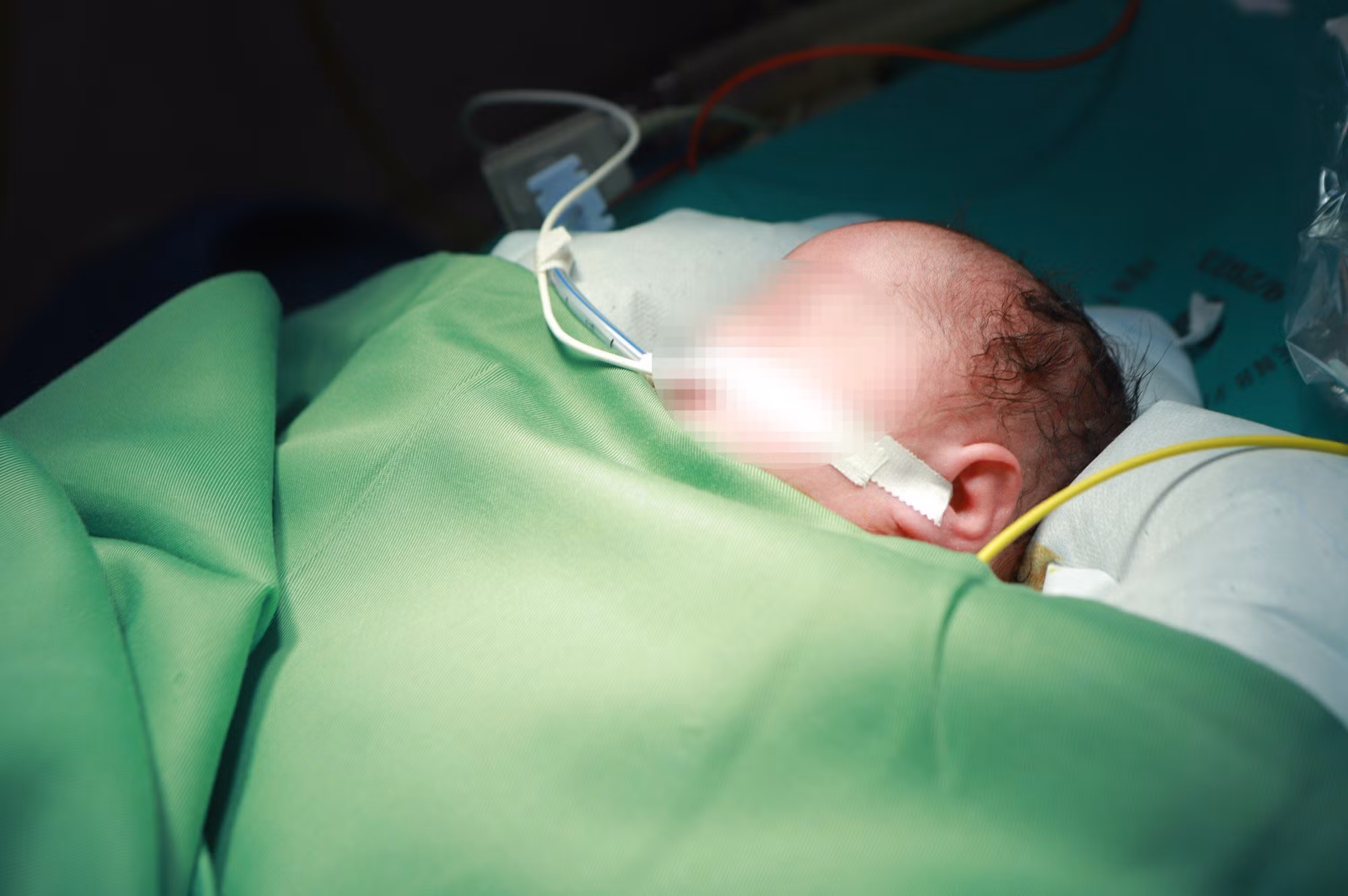 Em bé được hồi sức cấp cứu chuyển sang phòng mổ tim để đặt máy tạo nhịp tim. (Ảnh: BVCC) Em bé được hồi sức cấp cứu chuyển sang phòng mổ tim để đặt máy tạo nhịp tim. (Ảnh: BVCC)