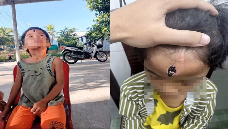 Vết thương cháu N.T.N. bị cha dượng đánh đập.