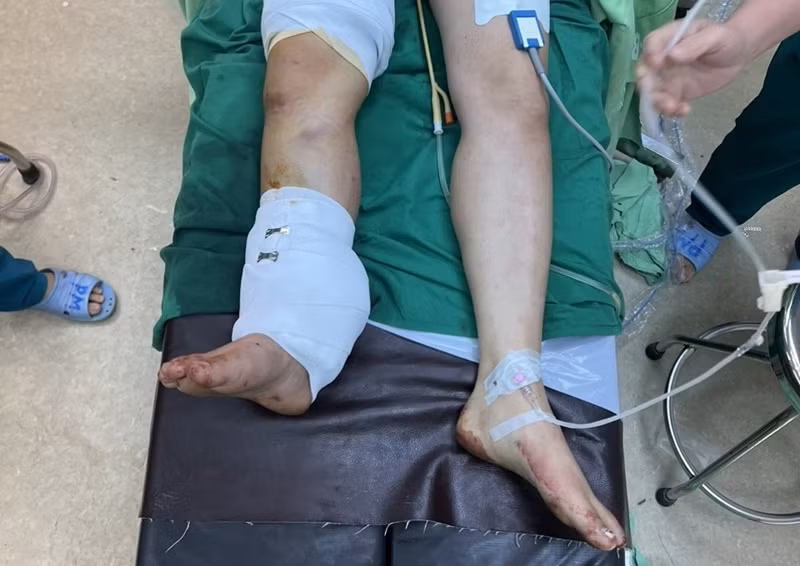 Do vết thương dập nát nên để khâu nối được vết thương, các bác sĩ đã phải cắt ngắn xương, mạch máu và gân mới có thể khâu nối được bàn chân cho bệnh nhân. Do vết thương dập nát nên để khâu nối được vết thương, các bác sĩ đã phải cắt ngắn xương, mạch máu và gân mới có thể khâu nối được bàn chân cho bệnh nhân.