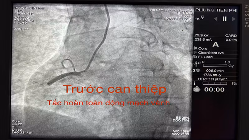Hình ảnh động mạch vành trước khi can thiệp của bệnh nhân Phùng Tiến Phi. (Ảnh: Bệnh viện Đa khoa tỉnh Hà Nam cung cấp) Hình ảnh động mạch vành trước khi can thiệp của bệnh nhân Phùng Tiến Phi. (Ảnh: Bệnh viện Đa khoa tỉnh Hà Nam cung cấp)