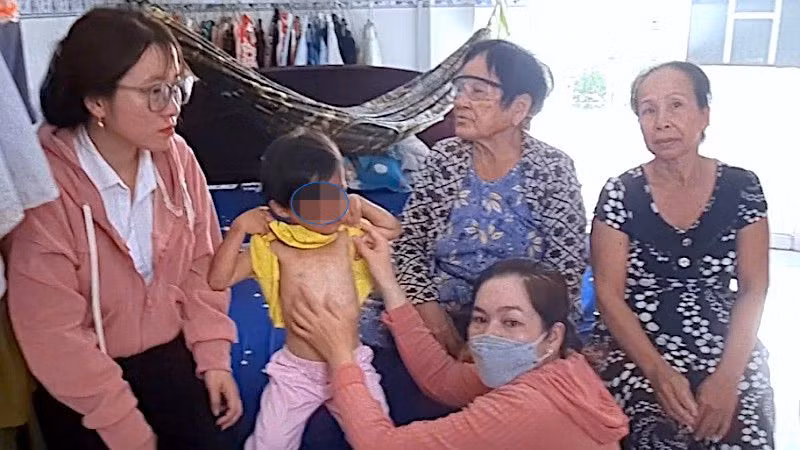 Lực lượng chức năng huyện Đầm Dơi (tỉnh Cà Mau) kiểm tra vết thương trên cơ thể cháu bé có dấu hiệu bị bạo hành.